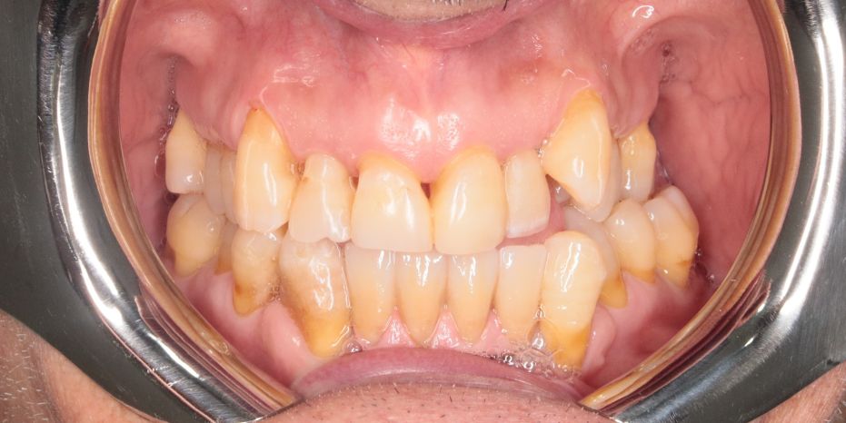 IMPLANTES DENTALES   MURCIA